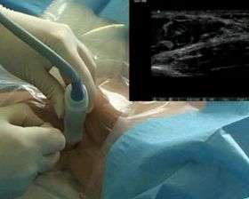 Video of an ultrasound-guided brachial plexus block