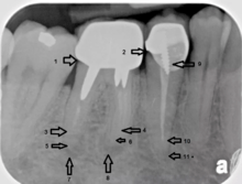 An X-ray explanation of bad root canal therapy