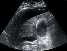 Ultrasound showing ascites as a dark area in the abdomen