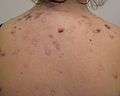 A photograph of a human back with nodular acne