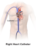 Right Heart Catheter