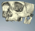 CT scans can be loaded to CAD/CAM software to create a simulation of the desired treatment. Virtual implants are then placed and a stent created on a 3D printer from the data.