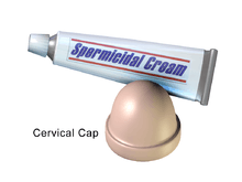 An illustration of a cervical cap and spermicidal cream