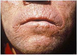 The skin of an adult face that is thickening with a waxy or leathery appearance, also with areas of hyperkeratosis