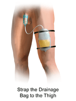 Condom Catheter Drainage Illustration