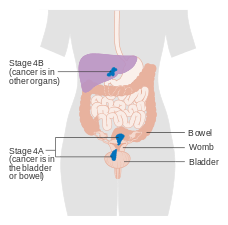 A diagram of stage IV endometrial cancer