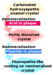 Carbonated hydroxyapatite enamel crystal is demineralised by acid in plaque and becomes partly dissolved crystal. This in turn is remineralised by fluoride in plaque to become a fluorapatite-like coating on remineralised crystal.