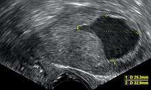 An ultrasound image showing an endometrial fluid accumulation (darker area) in a postmenopausal uterus, a finding that is highly suspicious for endometrial cancer