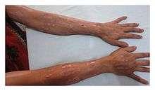 Multiple, well-demarcated, linear, longitudinal erosions on the dorsum of the bilateral forearms