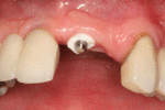 Abutment fracture