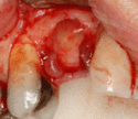 When mucosa is missing a free gingival graft of soft tissue can be transplanted to the area.