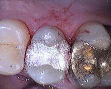 human teeth filled with shiny dental amalgam