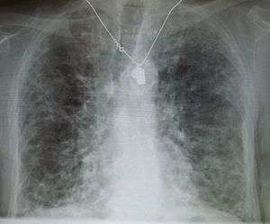 A chest X-ray demonstrating pulmonary fibrosis.  By history, the pulmonary fibrosis is thought to be due to amiodarone.