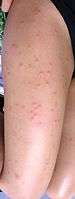Bites on thigh from sandfly