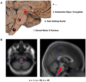 Composite of three images, one in top row (referred to in caption as A), two in second row (referred to as B). Top shows a mid-line sagittal plane of the brainstem and cerebellum. There are three circles superimposed along the brainstem and an arrow linking them from bottom to top and continuing upward and forward towards the frontal lobes of the brain. A line of text accompanies each circle: lower is "1. Dorsal Motor X Nucleus", middle is "2. Gain Setting Nuclei" and upper is "3. Substantia Nigra/Amygdala". The fourth line of text above the others says "4. ...". The two images at the bottom of the composite are magnetic resonance imaging (MRI) scans, one sagittal and the other transverse, centred at the same brain coordinates (x=-1, y=-36, z=-49). A colored blob marking volume reduction covers most of the brainstem.