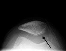 X-ray of a kneecap showing a different shaded area just beneath the kneecap