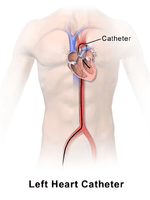 Left Heart Catheter