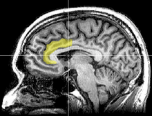 Sagittal MRI slice with highlighting indicating location of the anterior cingulate cortex.