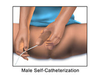 Image Male Self-Catheterization