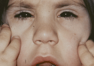 Image of a six-year-old female with Weill-Marchesani syndrome.