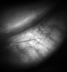 Meibomian glands in the lower eyelid imaged under amber light to show vasculature support and the gland structure [epiCam].