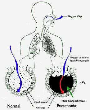 A schematic diagram of the human lungs with an empty circle on the left representing a normal alveola and one on the right showing an alveola full of fluid as in pneumonia