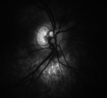 High detail picture of optic disc [epiCam].