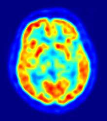 Sagittal PET scan at the level of the striatum. Hottest areas are the cortical grey matter and the striatum.