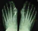 Painful hallux valgus and metatarsus primus varus deformities recurrence of left foot after osteotomy surgery