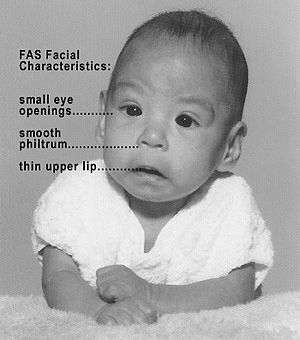 Image of Fetal Alcohol Syndrome