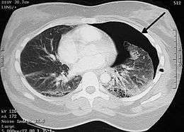 Image from a computed tomography (CT) scan of the chest. On the right (left side of the patient) there is a black area suggesting free air inside the chest