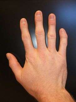 Photograph of right hand showing clinodactyly