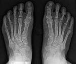 Severe bunion deformity correction without breaking bones or joint fusions was not deemed possible before osteodesis and syndesmosis procedures