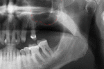 The maxillary sinus can limit the amount of bone height in the back of the upper jaw. With a "sinus lift", bone can be grafted under the sinus membrane increasing the height of bone.