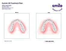 This is an example of a SmileDirectClub top teeth 3D treatment plan