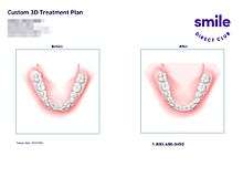 This is an example of a SmileDirectClub bottom teeth 3D treatment plan
