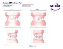 This is an example of a SmileDirectClub top and bottom teeth 3D treatment plan