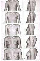 Tanner stages of breast development 1.jpg