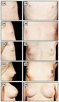 Tanner stages of breast development 2.jpg