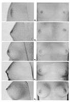 Tanner stages of breast development 3.jpg