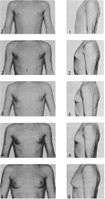 Tanner stages of breast development 4.jpg