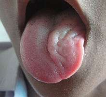 Image of a tongue protruding from a mouth, wasted on the left, and pointing to the left.