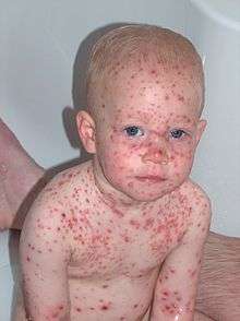 Multiple red papules scattered over a child's head, neck, trunk, and upper extremities